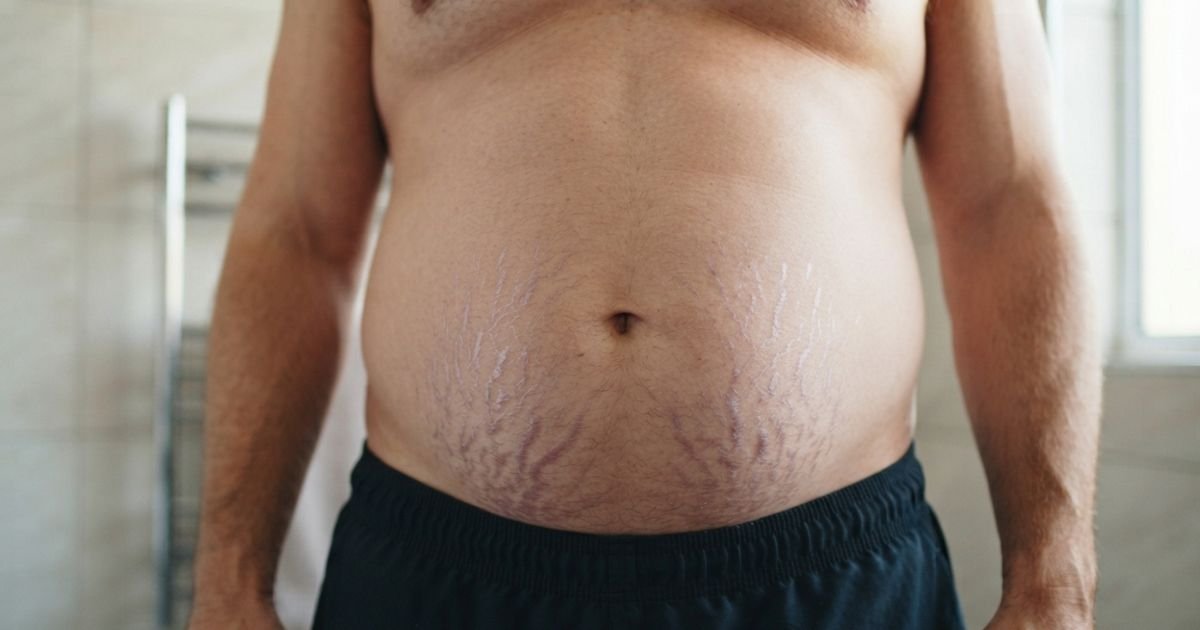 Estrias roxas e avermelhadas na barriga